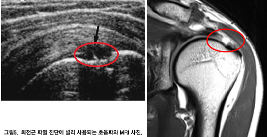 Ŭ ȸ Ŀ   ׸5. ȸ Ŀ ܿ θ Ǵ Ŀ MRI Դϴ.