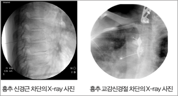 []  Ű  x-ray , []  Ű  x-ray 