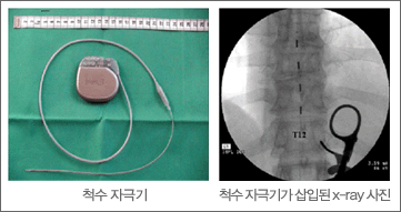 [] ô ڱر, [] ô ڱرⰡ Ե x-ray 