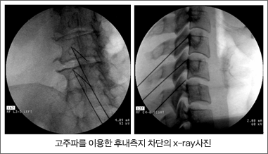 ĸ ̿ ĳ  x-ray 