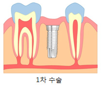 1 (öƮ ĸ) ׸