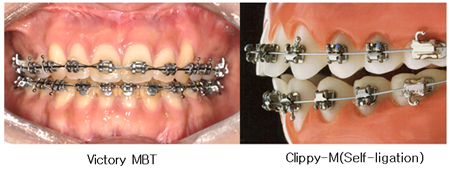 Metal bracket 