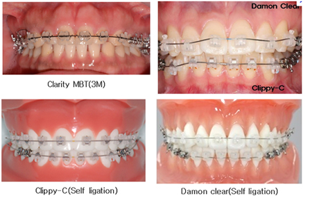 Ceramic  bracket 